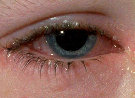 foto de conjuntivitis en ojo