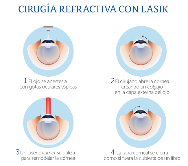 cirugía refractiva con LASIK